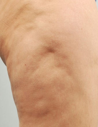 Smart Lipo before 606722