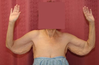 Brachioplasty or arm tuck in los angeles before 583676