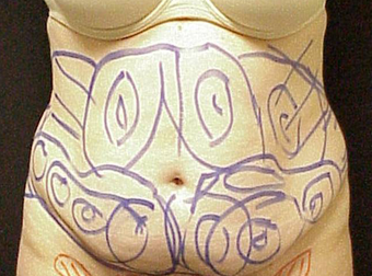 Tummy Liposuction before 229686
