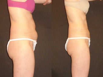 SmartLipo before 96269