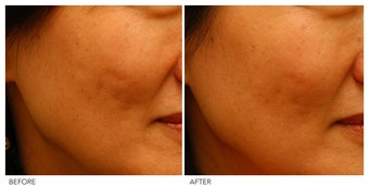 Acne Scarring Correction before 136806