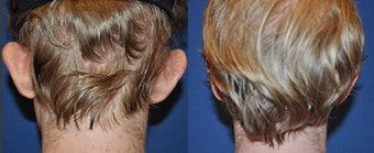 Otoplasty before 633522