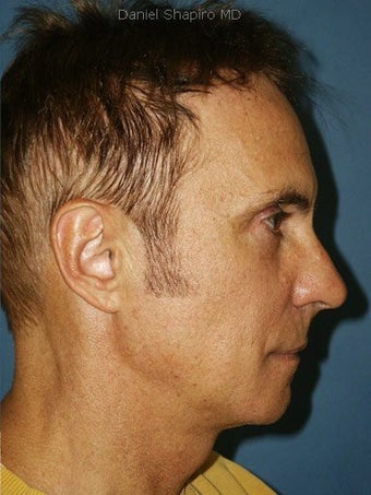 Chin augmentation, bilateral upper and lower blepharoplasty with canthopexy, and soft tissue fillers to the nasolabial folds after 250251