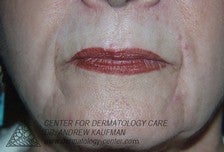 Dermal Filler Injection to Marionette and Accessory Smile Lines before 315163