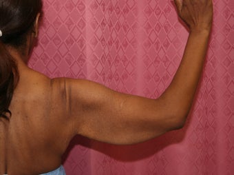 Brachioplasty or arm tuck before 583680