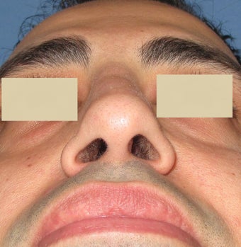 Rhinoplasty, Septoplasty after 127178