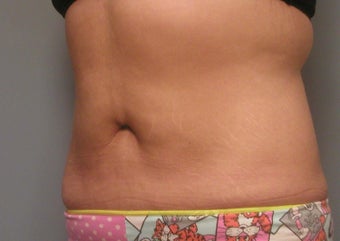 Body Jet and Slim Lipo after 208642
