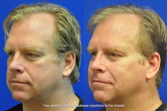 Radiesse Injection in Cheeks 403466