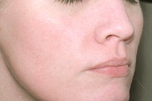 Laser Genesis for Overall Redness after 326789