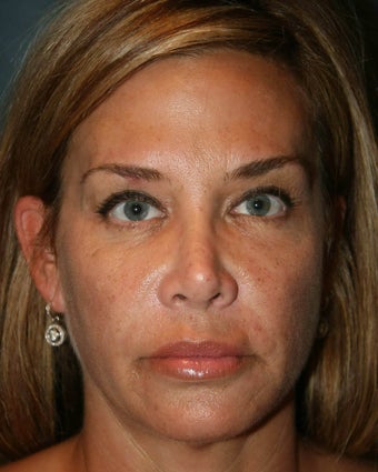 Ultherapy after 499168