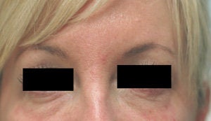 Bags under eyes before and after pictures Juvederm before 204772