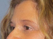 Brow Lift 541473