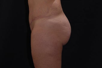 Buttock Augmentation through Fat Transfer 423709