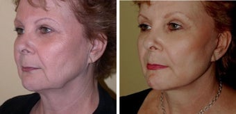 Necklift after 359787
