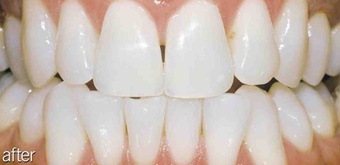 Teeth whitening genetic after 234636