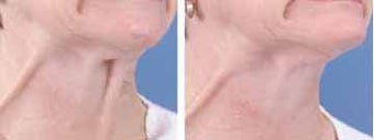 Botox for Neck bands before 6324