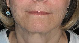 "Liquid facelift" with filler after 327865