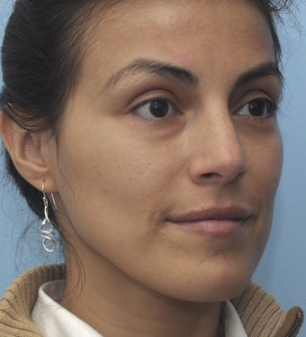 Eye Dermafillers,Cheek Dermafillers,Facial Dermafillers 454584