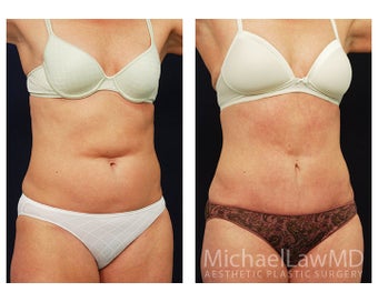 Abdominoplasty - Tummy Tuck after 396121