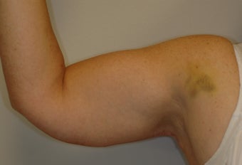 Arm Lift after 536869