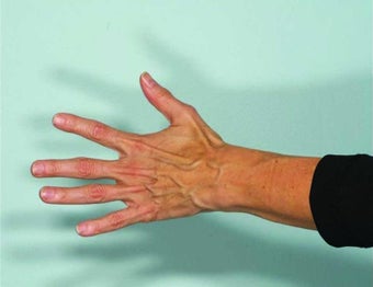 Radiesse hand rejuvenation before 349882