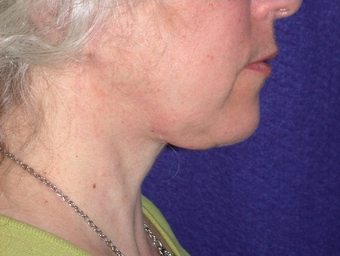 Necklift 208456