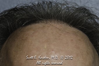 AccuGraft Hair Transplant before 589495