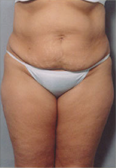 Tummy Tuck before 428193