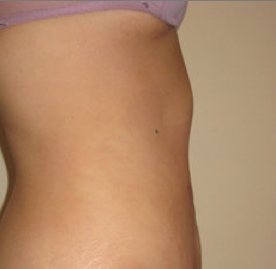 Laser Surgery after 362290