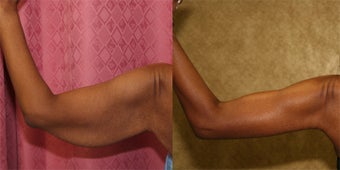 brachioplasty before 242121
