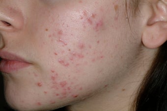 Acne and Isolaz before 95913