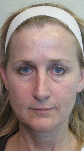 Sculptra and juvederm 582244