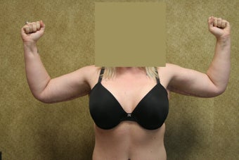 Brachioplasty or arm tuck after 583681