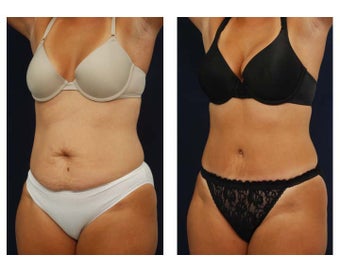 Tummy Tuck or Abdominoplasty before 283165