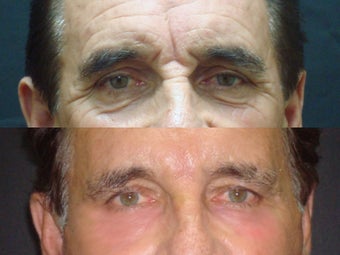 Botox before 242419