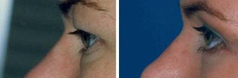 Blepharoplasty before 643244