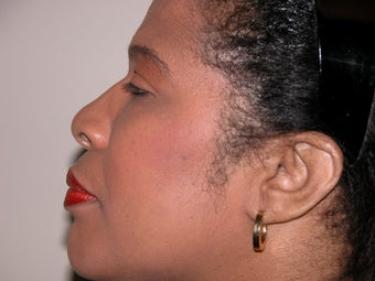 Rhinoplasty before 296151