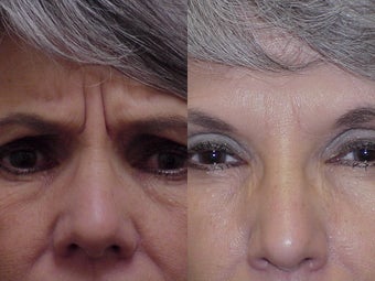 Botox before 396255