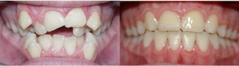 Before and after orthodontic treatment before 300714