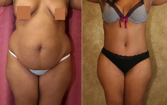 tummy tuck 304683