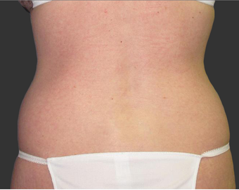 Exilis after 423761