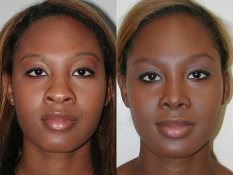 African American Rhinoplasty before 210166