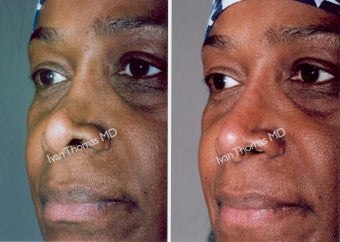 Non Surgical Rhinoplasty before 243654