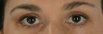 Botox after 100336