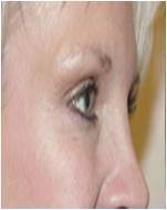 Botox after 396256