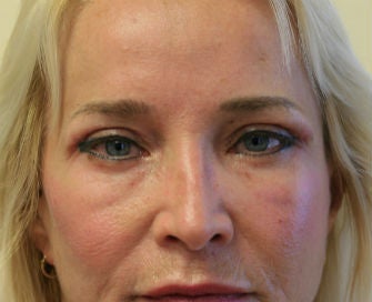 Eyelid rejuvenation before 378919