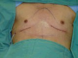 Chest Wall Reconstruction Surgery after 145937