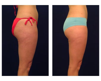 Liposuction before 286667