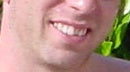 Invisalign before 109163