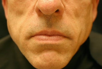 Sculptra after 451778
